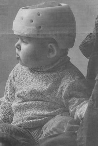 occipital-plagiocephaly-helmet